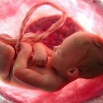 شایع‌ترین علت سقط مکرر زودرس چیست؟