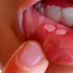 آفت دهان چیست؟ +علایم و درمان